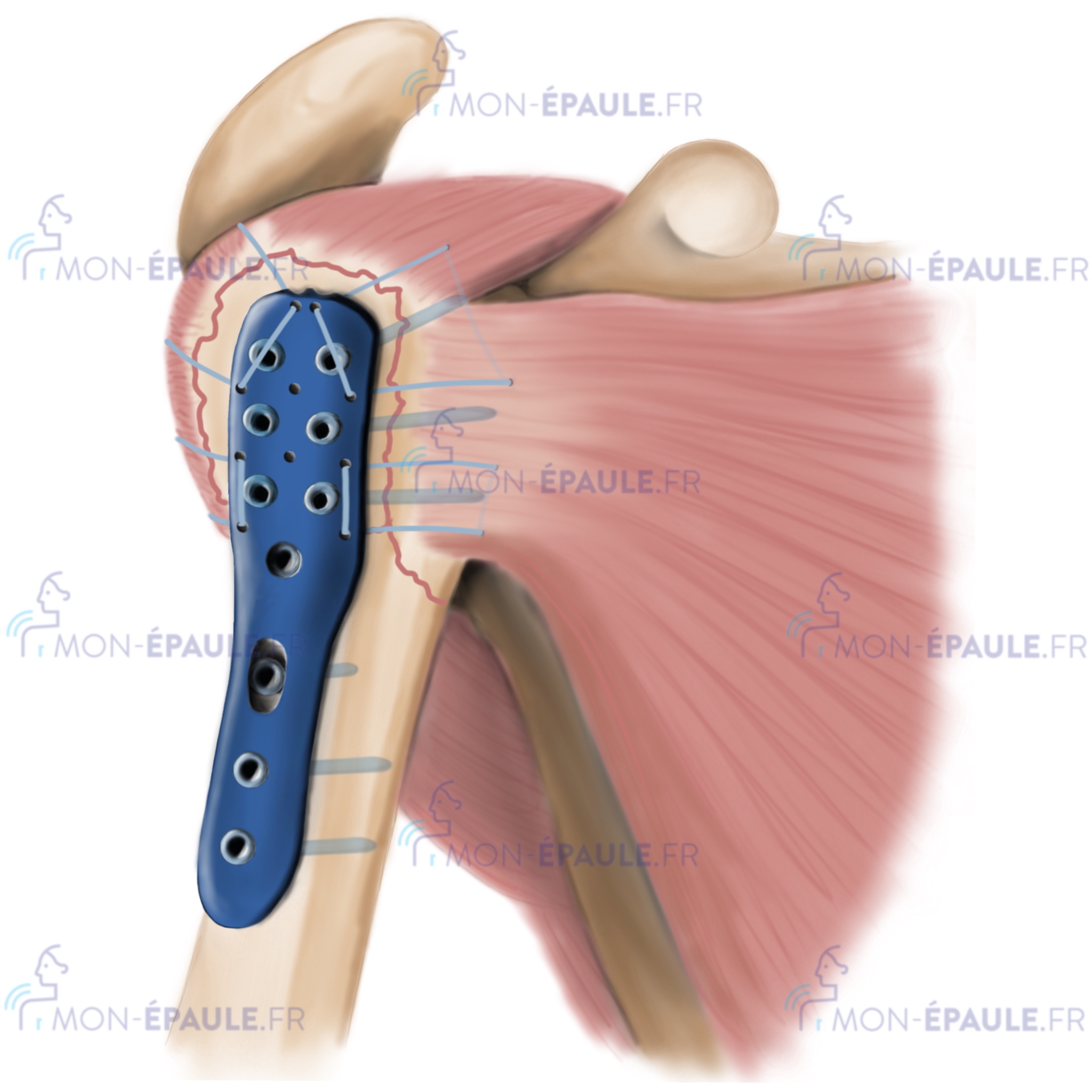 Illustration médicale d'une fracture de la tête humérale réparée par une plaque et des vis